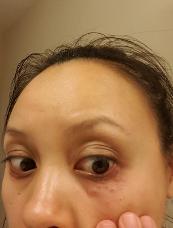 After wiping off treatment of syringoma